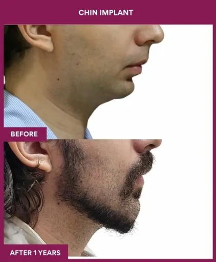 11 Chin Implant