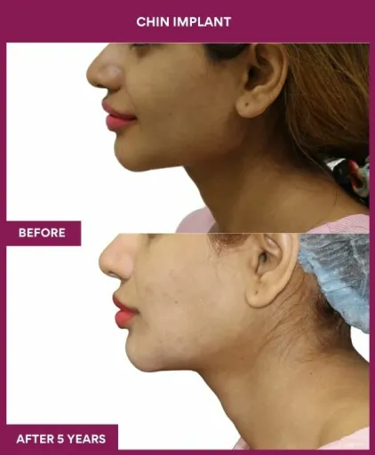 5 Chin Implant (3)