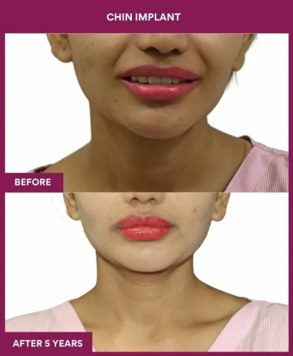 5 Chin Implant