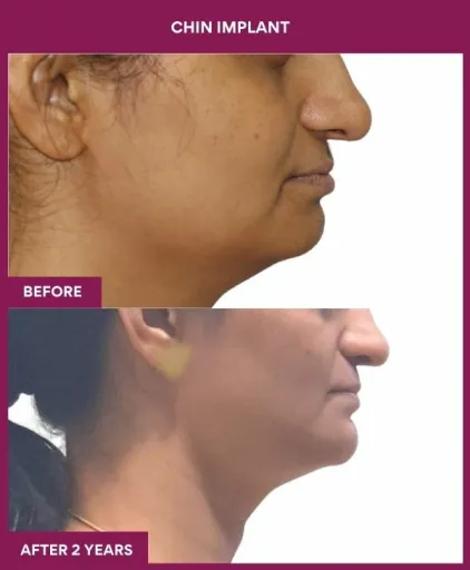 6 Chin Implant (3)