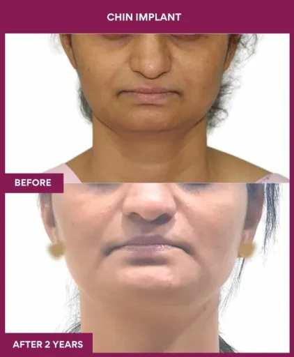 6 Chin Implant
