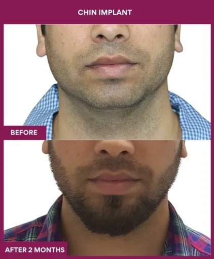 7 Chin Implant