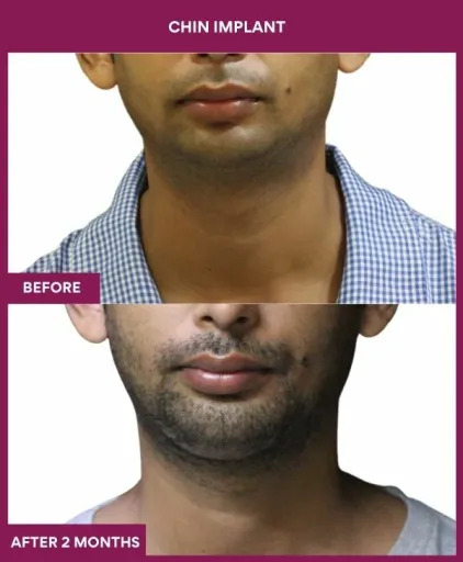 8 Chin Implant