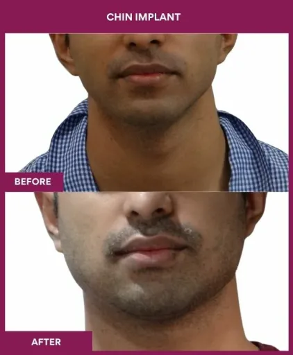 9 Chin Implant
