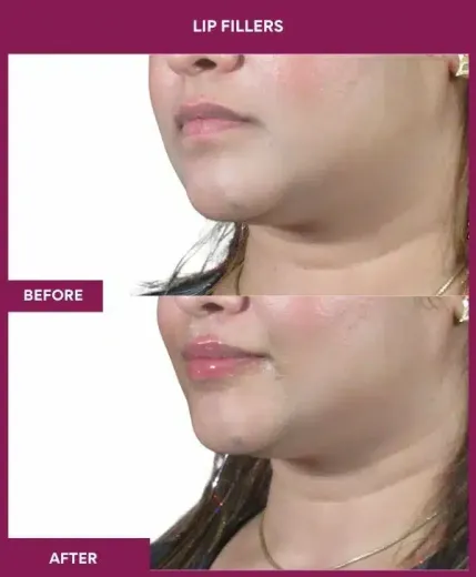 Lip filler enhancement before and after by Dr Milan Doshi Mumbai – left profile