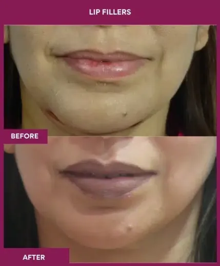 Before and after lip filler treatment in Mumbai by cosmetic surgeon Dr Milan Doshi – front view