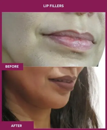 Lip filler procedure results by Dr Milan Doshi Mumbai – right profile
