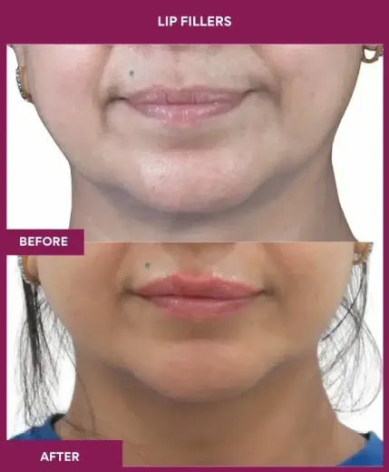 Lip augmentation before and after results by Dr Milan Doshi in Mumbai – front view