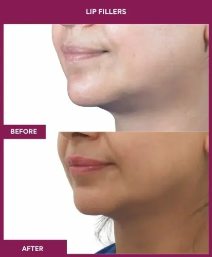 Natural looking lip filler results Mumbai clinic – left side profile