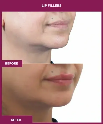 Cosmetic lip filler treatment results by Dr Milan Doshi – right profile