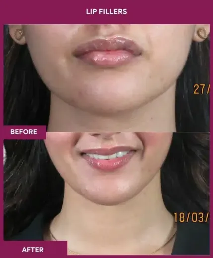Lip filler treatment results in Mumbai by Dr Milan Doshi – front view