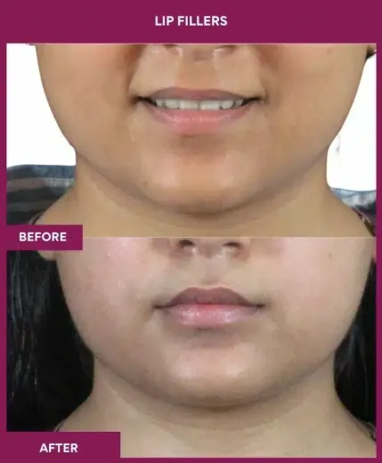 Lip filler cosmetic treatment results in Mumbai – front view by Dr Milan Doshi
