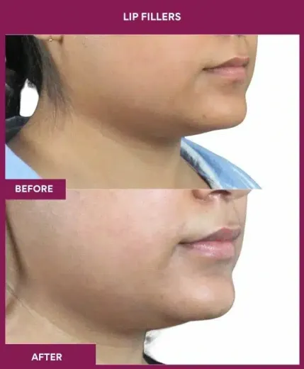 Lip filler results by celebrity cosmetic surgeon Dr Milan Doshi – right view