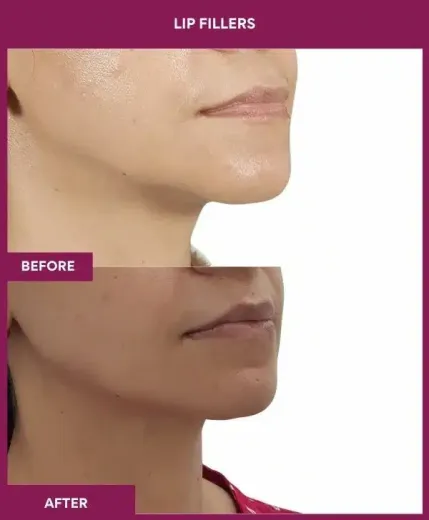 Natural lip filler results by Dr Milan Doshi – right profile