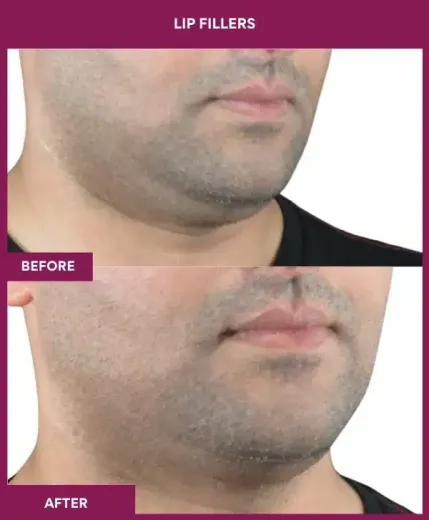 Lip filler enhancement results Mumbai – right side view
