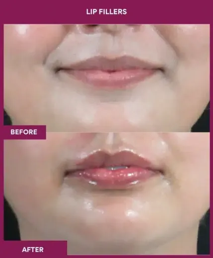 Before after lip filler results Mumbai by Dr Milan Doshi – front view