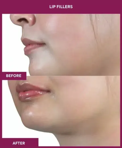 Lip filler treatment Mumbai clinic results – left profile