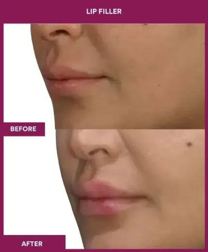 Lip filler treatment results by Dr Milan Doshi – left profile
