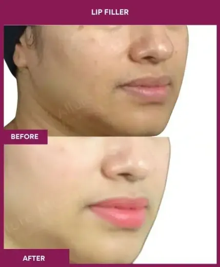 Lip filler treatment results by Dr Milan Doshi – right view