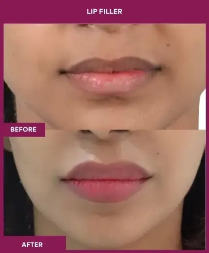 Lip filler treatment before after Mumbai aesthetic clinic – front view