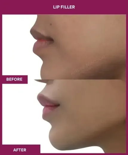 Lip augmentation results Mumbai cosmetic surgeon – left profile