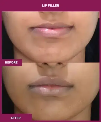 Natural lip filler results by Dr Milan Doshi Mumbai – front view