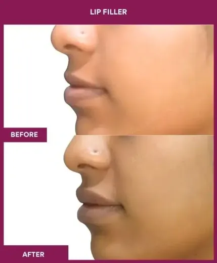Lip volume enhancement before after Mumbai clinic – left profile