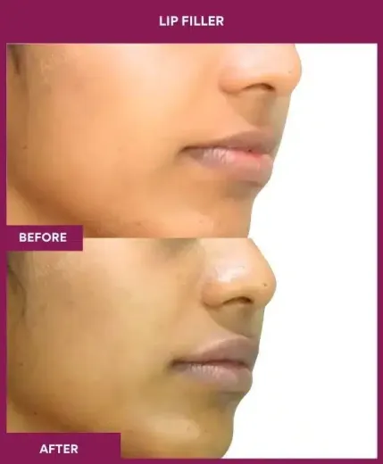 Lip filler aesthetic improvement by Dr Milan Doshi – right view