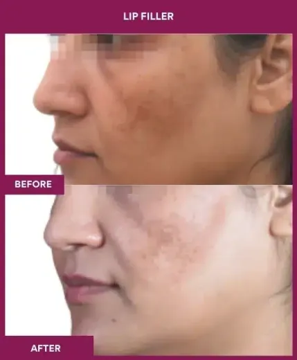 Lip filler treatment Mumbai aesthetic clinic – left profile