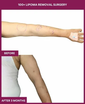 Lipoma Removal Surgery 16 1 100+ Lipoma Removal Surgery (3)