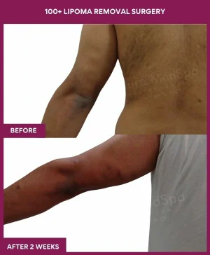 Lipoma Removal Surgery 45 10 100+ Lipoma Removal Surgery (3)