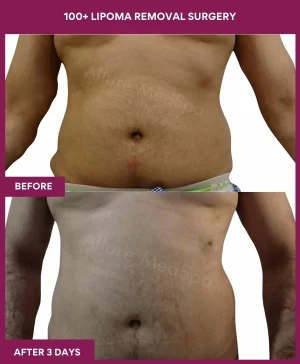 Lipoma Removal Surgery 2 11 100+ Lipoma Removal Surgery