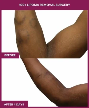 Lipoma Removal Surgery 49 12 100+ Lipoma Removal Surgery