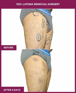 Lipoma Removal Surgery 10 2 100+ Lipoma Removal Surgery (2)