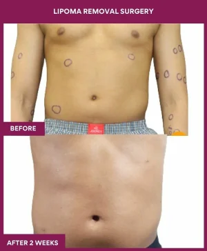 Lipoma Removal Surgery 7 2 Lipoma Removal Surgery