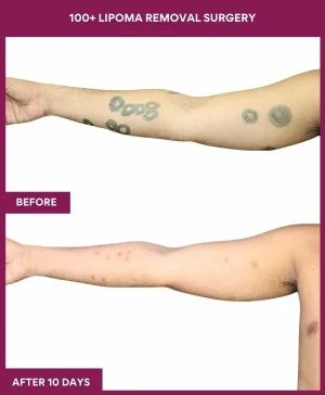 Lipoma Removal Surgery 18 3 100+ Lipoma Removal Surgery