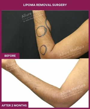 Lipoma Removal Surgery 21 3 Lipoma Removal Surgery (2)