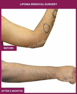 Lipoma Removal Surgery 22 3 Lipoma Removal Surgery (3)