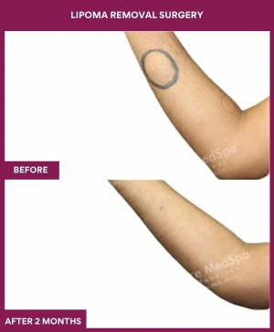 Lipoma Removal Surgery 20 3 Lipoma Removal Surgery