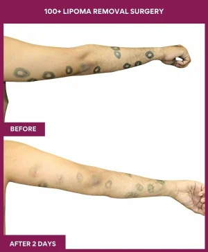 Lipoma Removal Surgery 24 4 100+ Lipoma Removal Surgery (3)