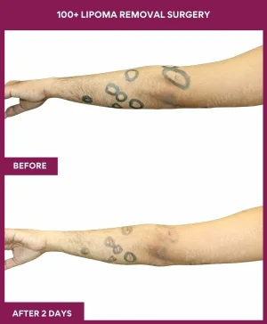 Lipoma Removal Surgery 25 4 100+ Lipoma Removal Surgery (4)