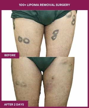 Lipoma Removal Surgery 23 4 100+ Lipoma Removal Surgery