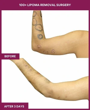 Lipoma Removal Surgery 30 5 100+ Lipoma Removal Surgery