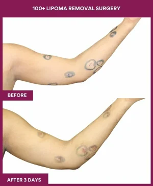 Lipoma Removal Surgery 29 5 100+ Lipoma Removal Surgery (2)