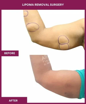 Lipoma Removal Surgery 12 5 Lipoma Removal Surgery (2)