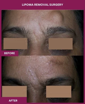 Lipoma Removal Surgery 11 7 Lipoma Removal Surgery