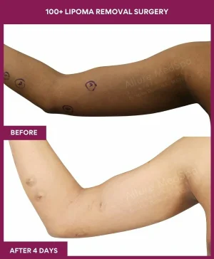 Lipoma Removal Surgery 38 8 100+ Lipoma Removal Surgery (2)