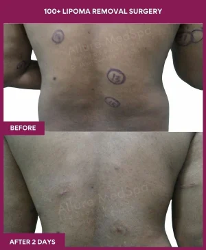 Lipoma Removal Surgery 42 9 100+ Lipoma Removal Surgery