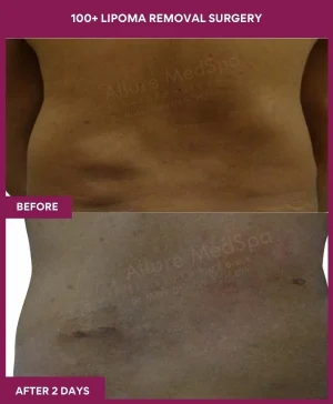 Lipoma Removal Surgery 41 9 100+ Lipoma Removal Surgery (2)