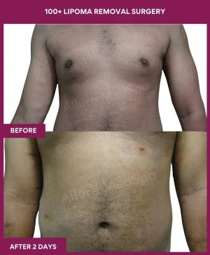 Lipoma Removal Surgery 40 9 100+ Lipoma Removal Surgery